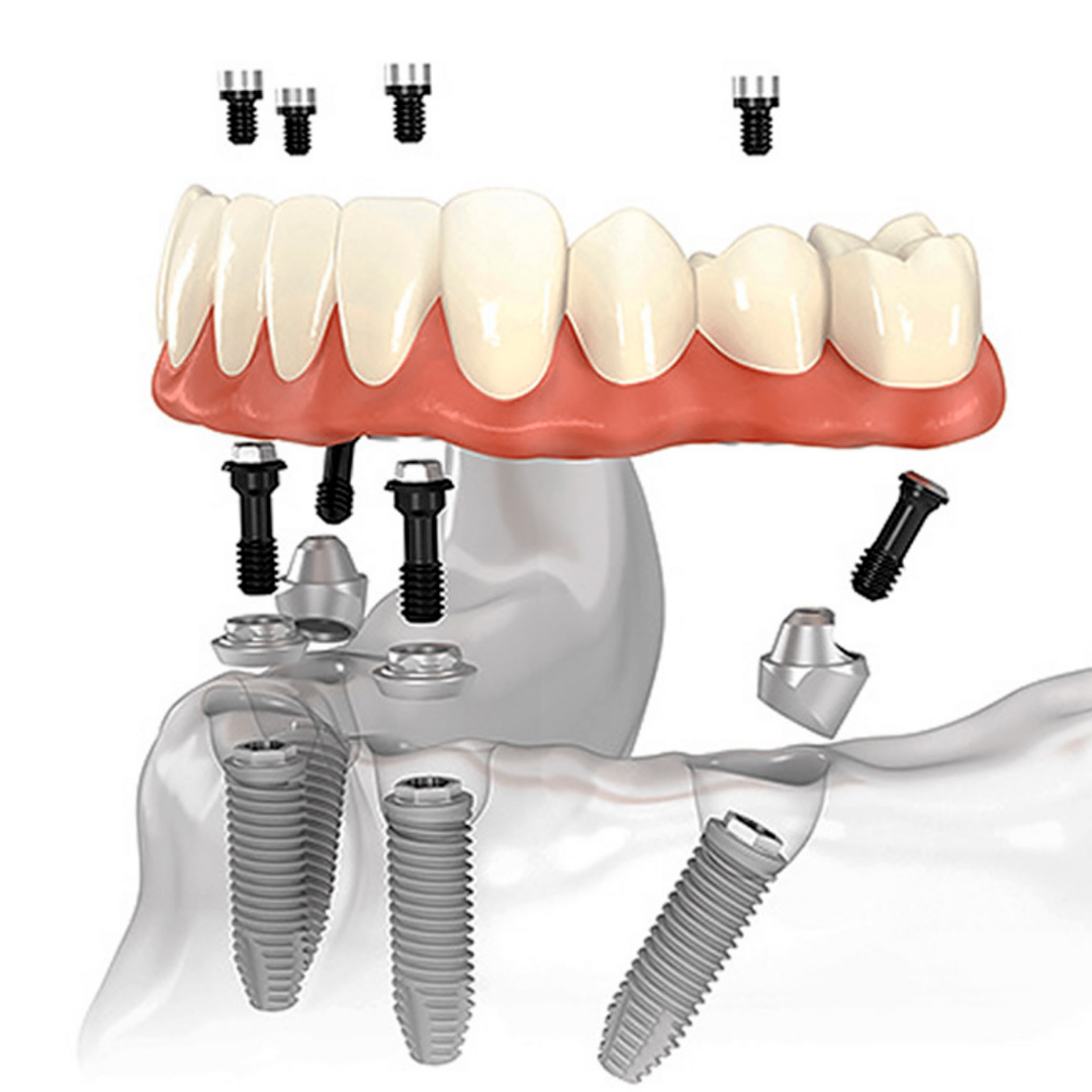 Carga imediata — dentes fixos no mesmo dia