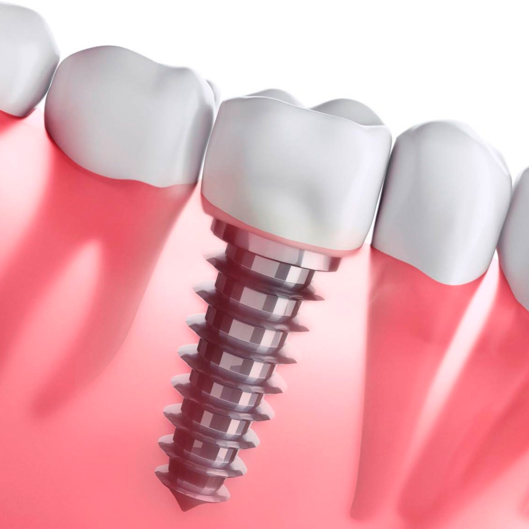 Implante dentário