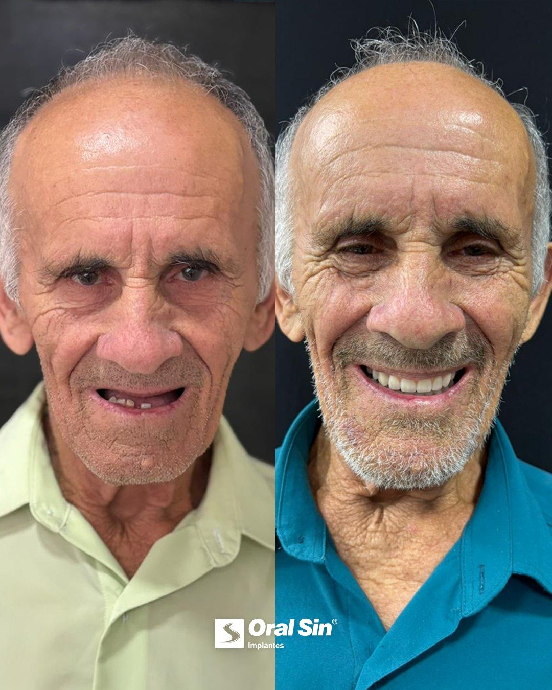 Caso de antes e depois — implante dentário Oral Sin
