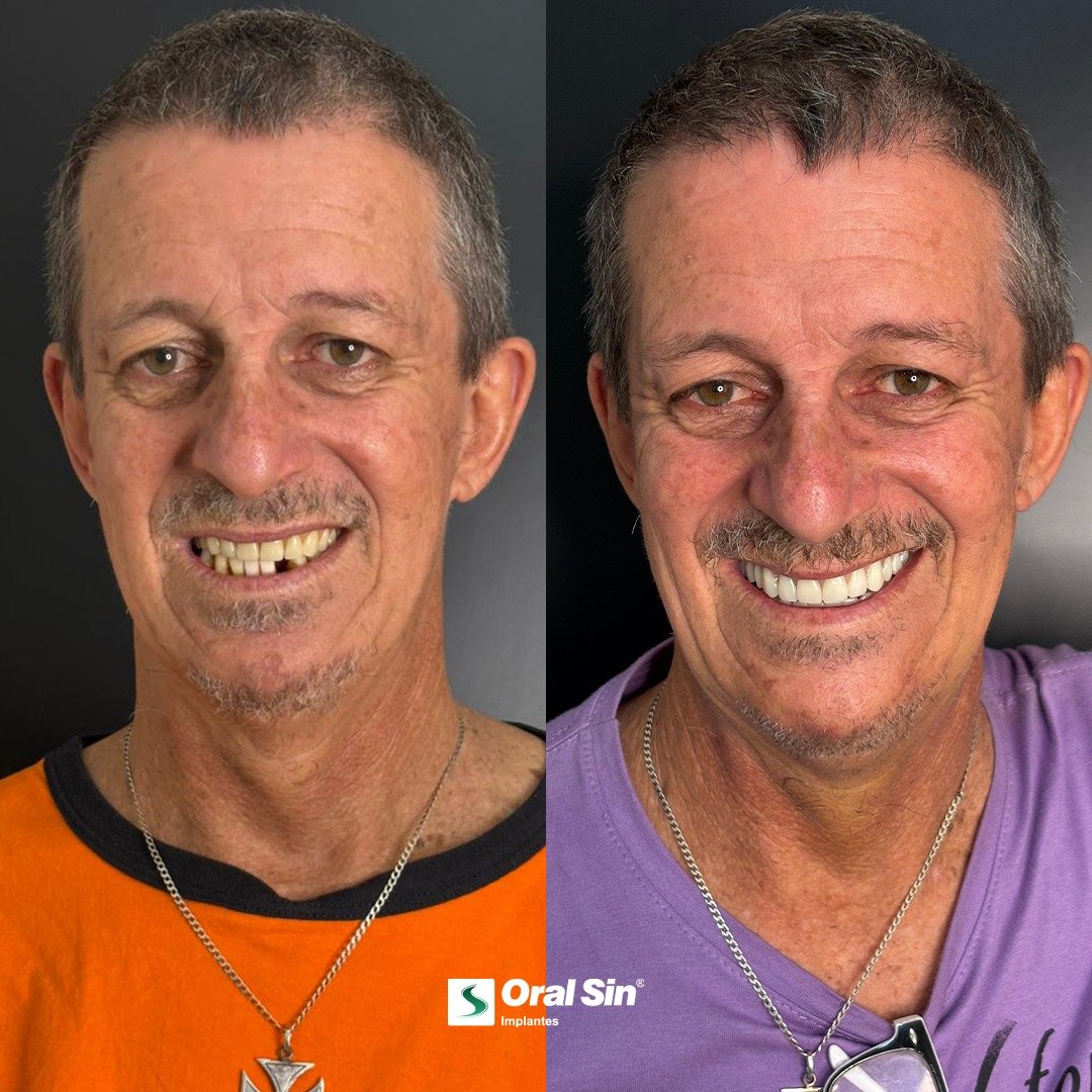 Caso de antes e depois — prótese protocolo Oral Sin