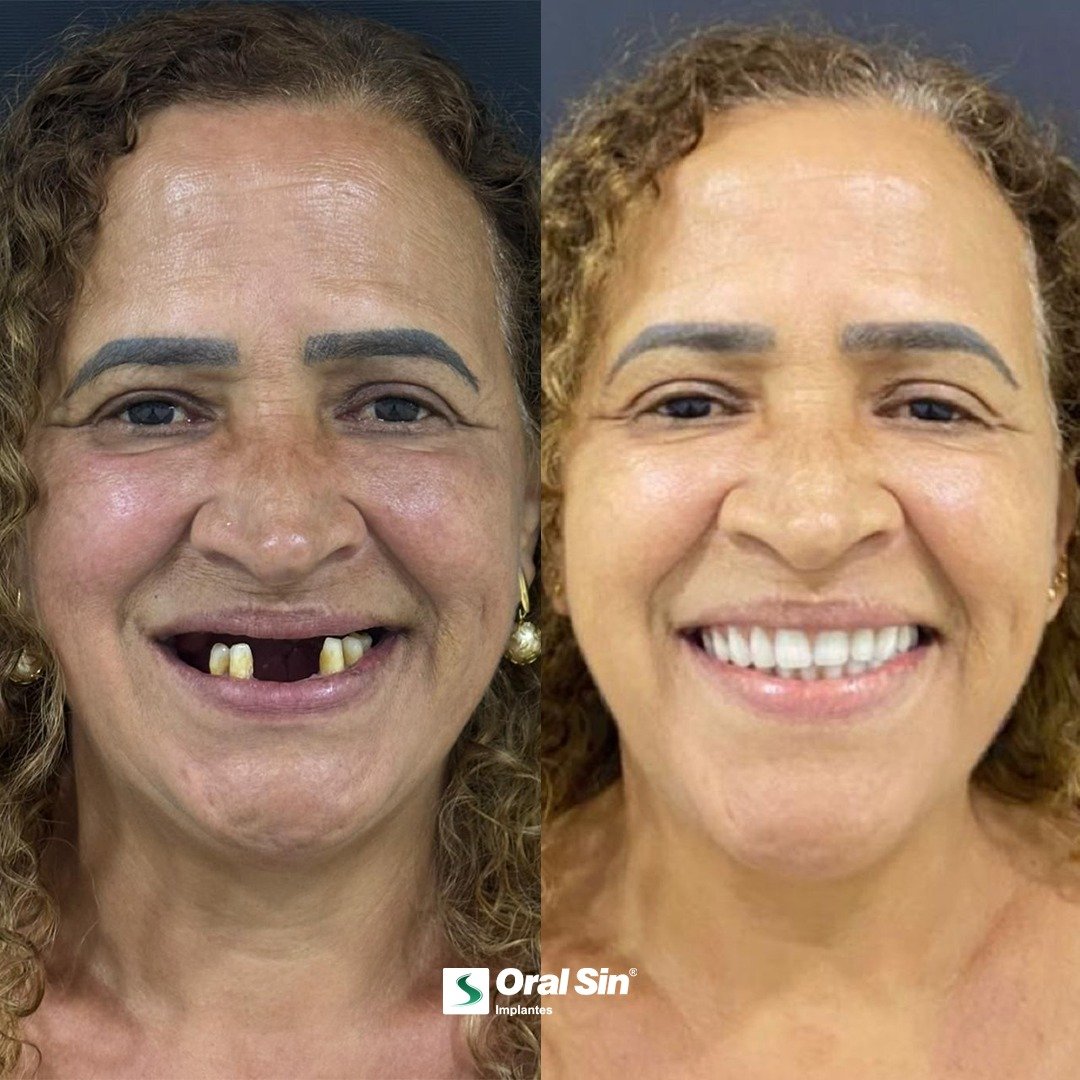 Caso de antes e depois — reabilitação oral Oral Sin