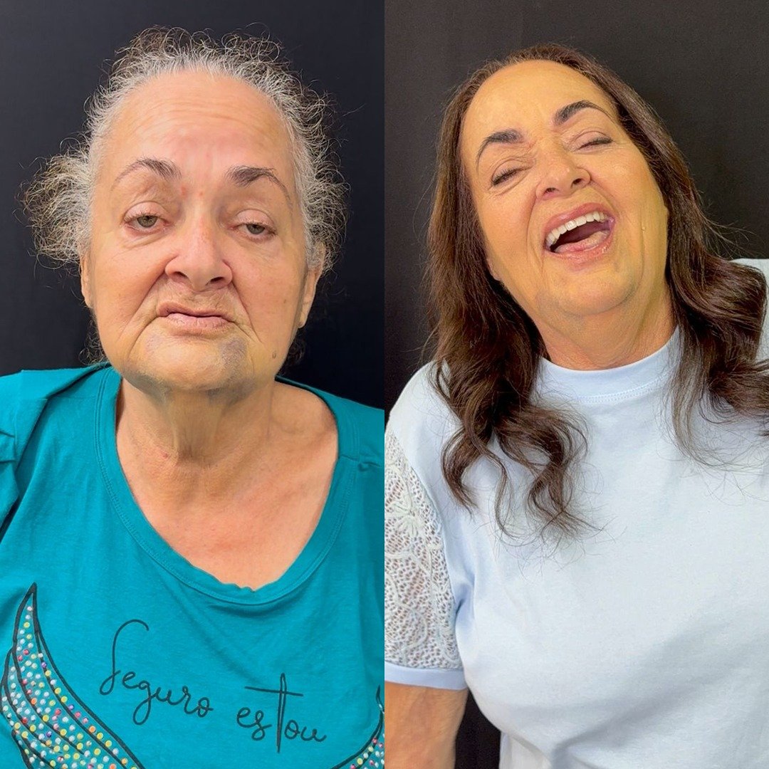 Caso de antes e depois — implante dentário Oral Sin