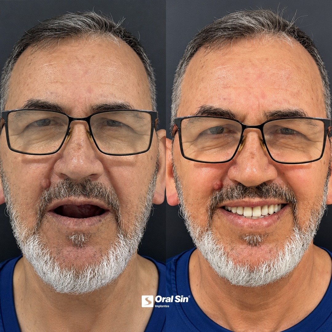Caso de antes e depois — prótese protocolo Oral Sin