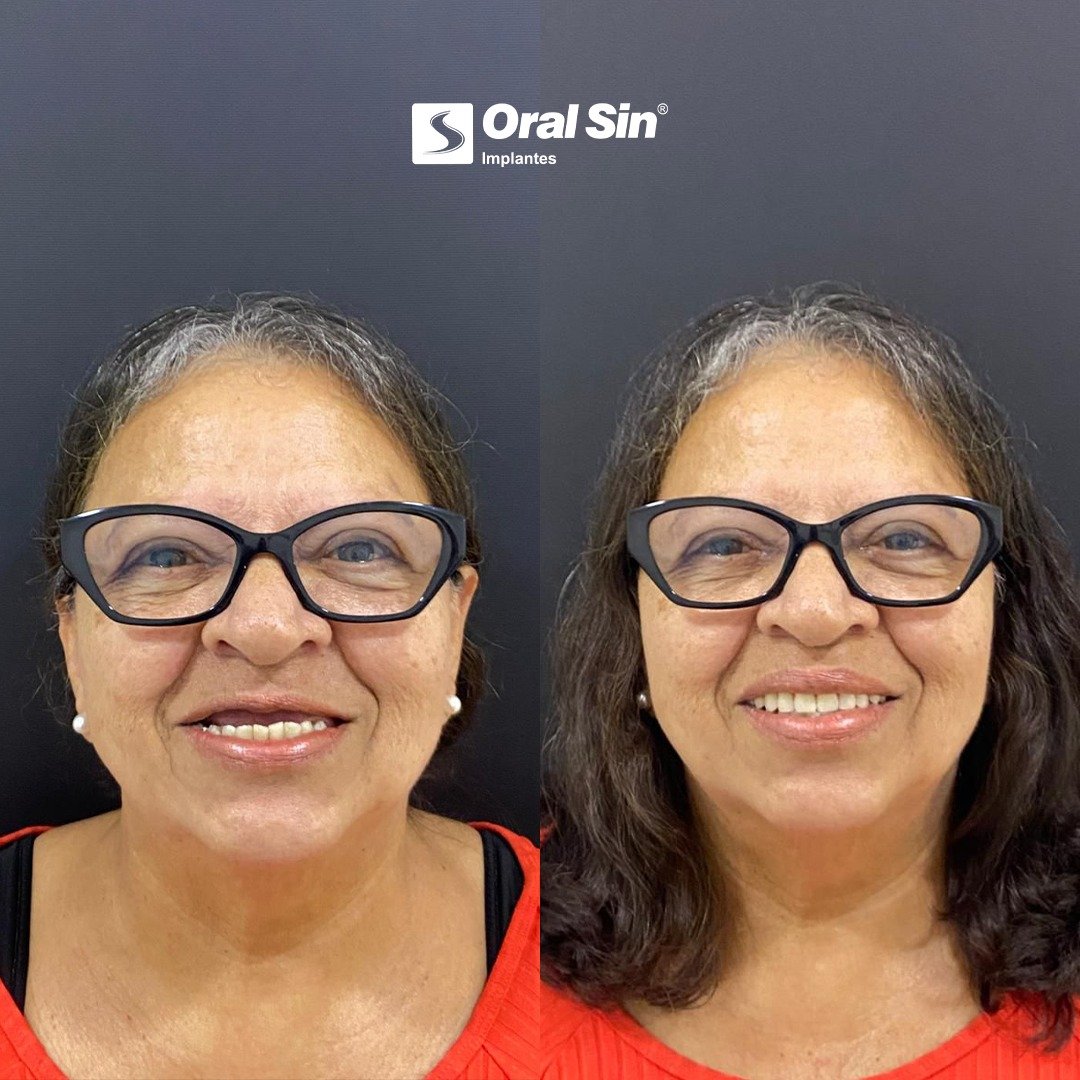 Caso de antes e depois — reabilitação oral Oral Sin