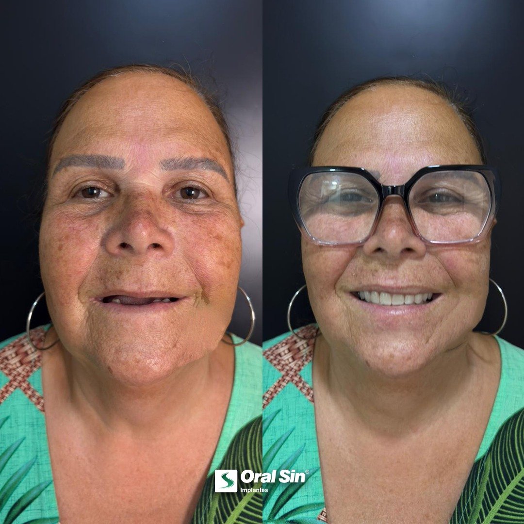 Caso de antes e depois — implante dentário Oral Sin