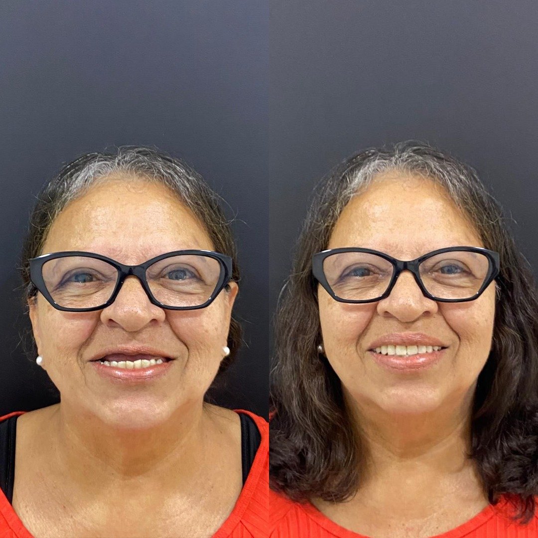 Caso de antes e depois — prótese protocolo Oral Sin