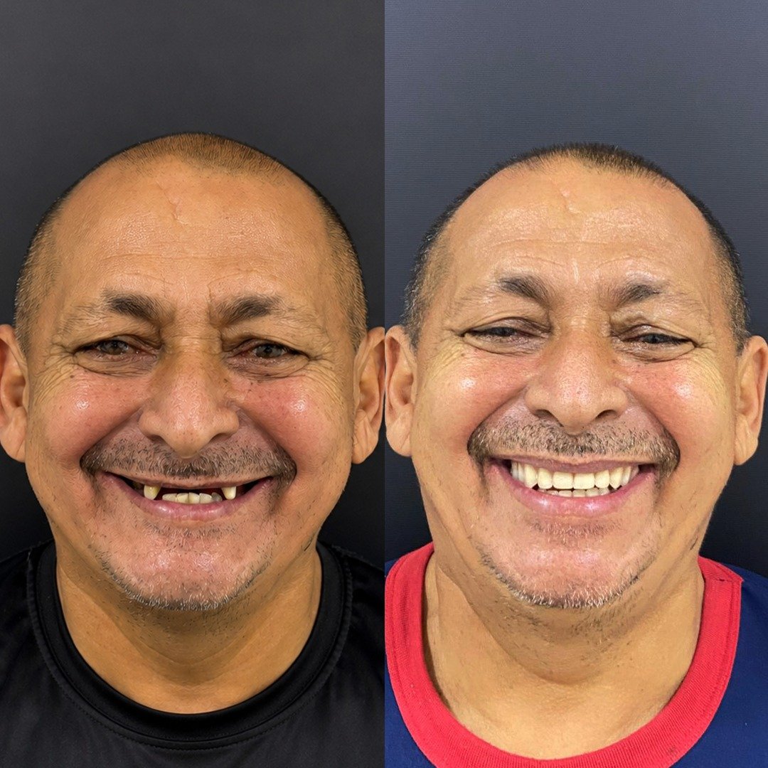 Caso de antes e depois — reabilitação oral Oral Sin