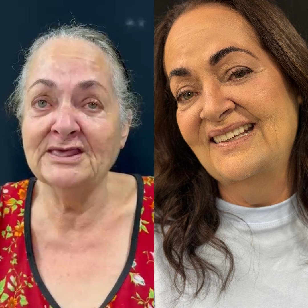 Caso de antes e depois — implante dentário Oral Sin